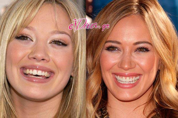 Δείτε-το-χαμόγελο-10-celebrities-Πριν-και-Μετά-την-αισθητική-ιατρική-www.ediva_.gr-1