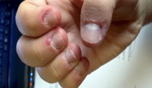μόλυνση όταν τρως τα νύχια σου
